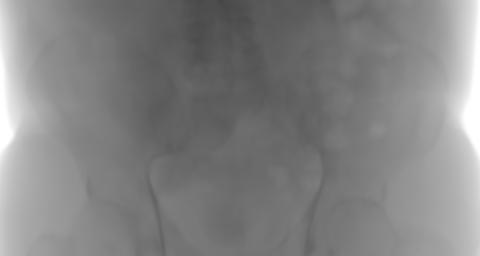 Expected primary counts from the synthetic pelvic CT at the reference pose.