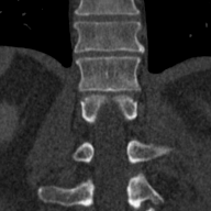 Native acquired coronal CT crop at y=5.81543 mm; x increases right and z increases up.