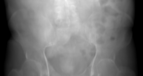 Primary projection of the synthetic pelvis at its reference pose. Higher optical depth is lighter.