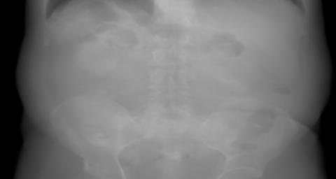 AP primary projection of the synthetic abdomen candidate. The beam travels anterior → posterior.