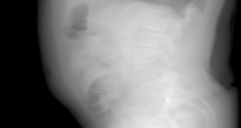 Right-to-left lateral primary projection of the synthetic abdomen candidate. The beam travels right → left.