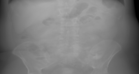 PA primary projection of the synthetic abdomen candidate. The beam travels posterior → anterior.