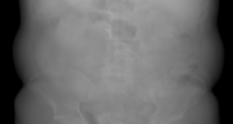 AP primary projection of the synthetic chest candidate. The beam travels anterior → posterior.
