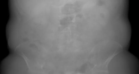 PA primary projection of the synthetic chest candidate. The beam travels posterior → anterior.