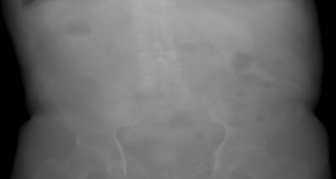 Synthetic pelvic AP projection at zero rotation about the centre of the native volume.