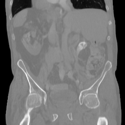 Actual middle coronal slice of the synthetic pelvic CT. Top S, left L.