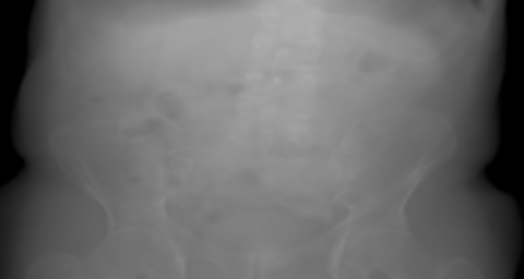 PA primary projection of the synthetic pelvis candidate. The beam travels posterior → anterior.