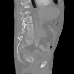 Actual middle sagittal slice of the synthetic pelvic CT. Top S, left P.