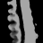 Assigned reference, bone fraction, sagittal (x = 0 mm)